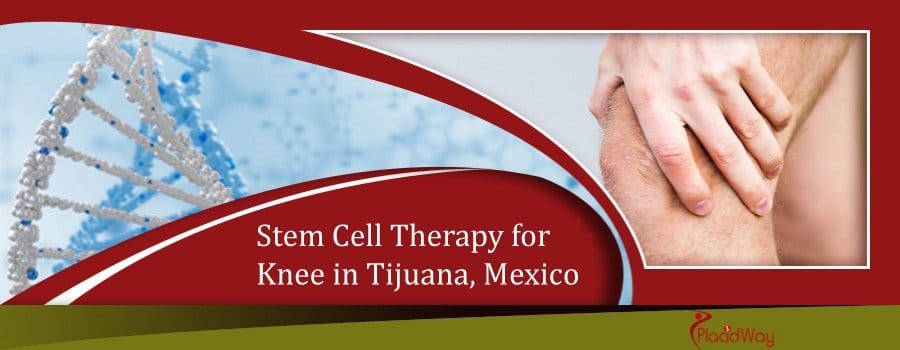 Stem cell therapy for knee in Tijuana Mexico