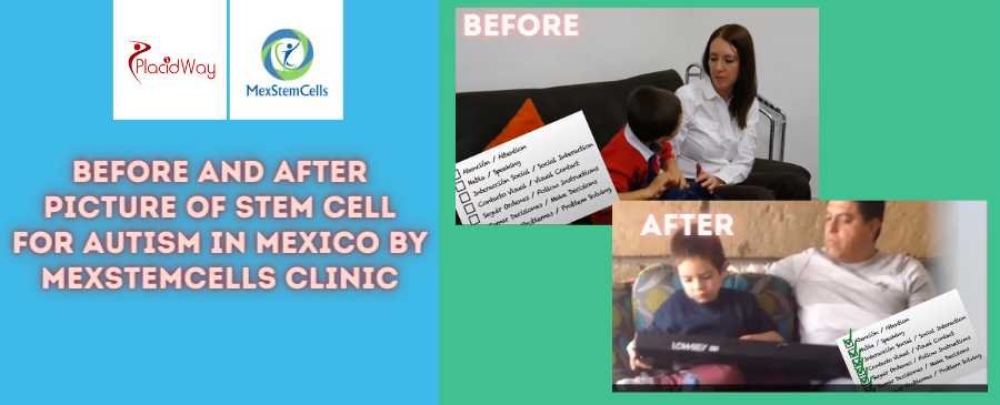 Before-and-After-Picture-of-Stem-Cell-Therapy-in-Mexico-City-Mexico-at-MexStemCells-Clinic