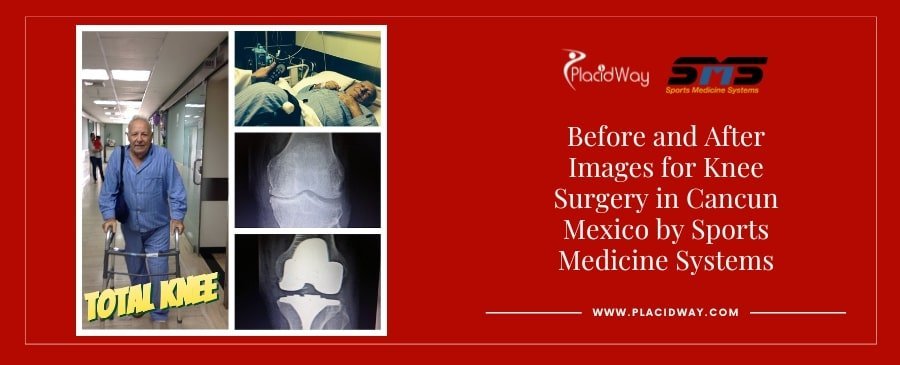Before-and-After orthopedic Surgery
