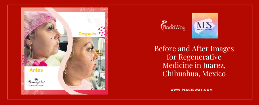 Before and After Images for Regenerative Medicine in Juarez, Chihuahua, Mexico