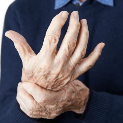 Rheumatoid Arthritis