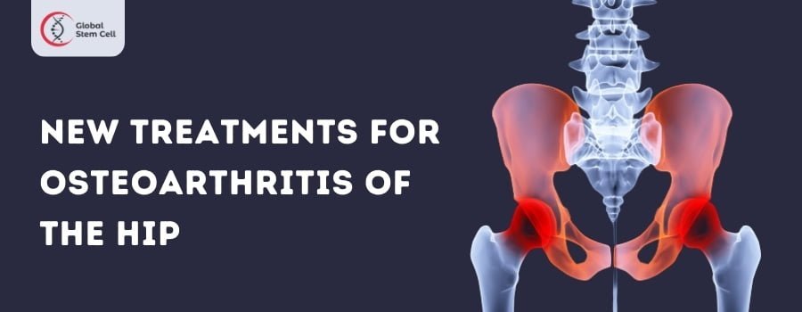 Read more about the article New Treatments for Osteoarthritis of the Hip