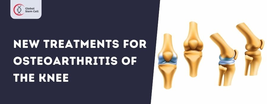 Read more about the article New Treatments for Osteoarthritis of the Knee