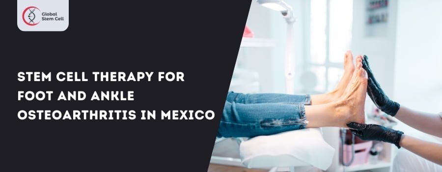Read more about the article Stem Cell Treatment for Foot and Ankle Osteoarthritis in Mexico