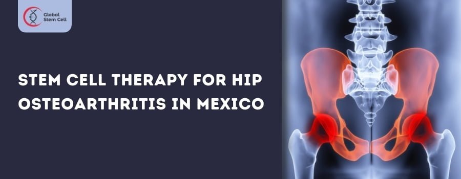 Read more about the article Explore Stem Cell Therapy for Osteoarthritis of the Hip in Mexico