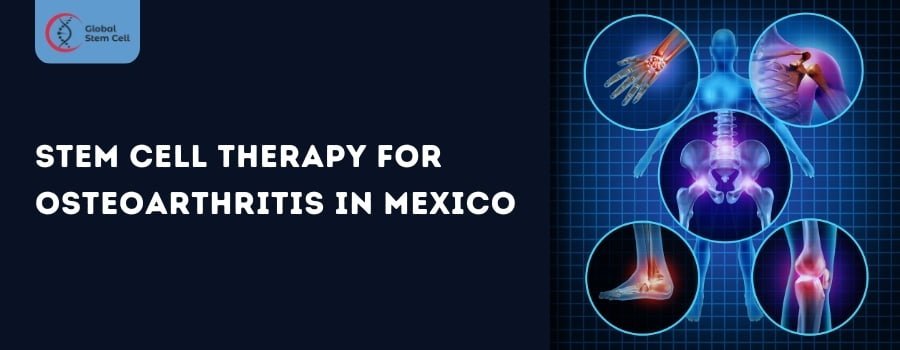 Read more about the article Unlocking Hope – Stem Cell Therapy for Osteoarthritis in Mexico