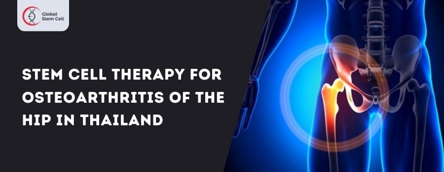Read more about the article Stem Cell Treatment for Osteoarthritis of the Hip in Thailand