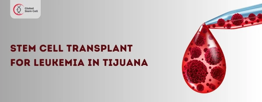 Stem Cell Transplant for Leukemia in Tijuana Mexico