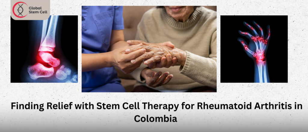 Finding Relief with Stem Cell Therapy for Rheumatoid Arthritis in Colombia