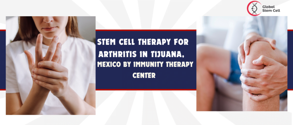 Stem Cell Therapy for Arthritis in Tijuana, Mexico by Immunity Therapy Center 