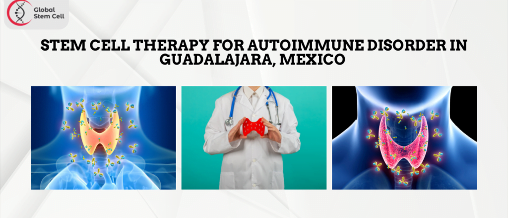 Stem Cell Therapy for Autoimmune Disorder in Guadalajara, Mexico