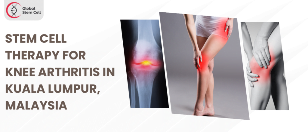 Stem Cell Therapy for Knee Arthritis in Kuala Lumpur, Malaysia