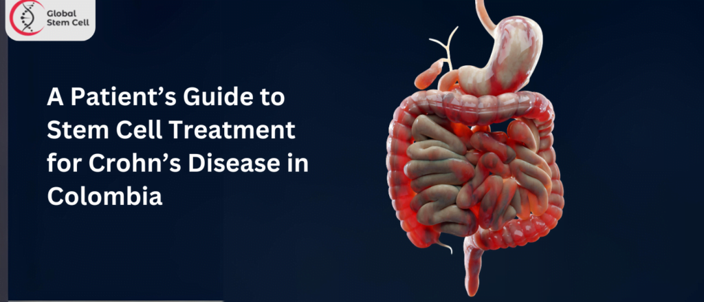 A Patient’s Guide to Stem Cell Treatment for Crohn’s Disease in Colombia