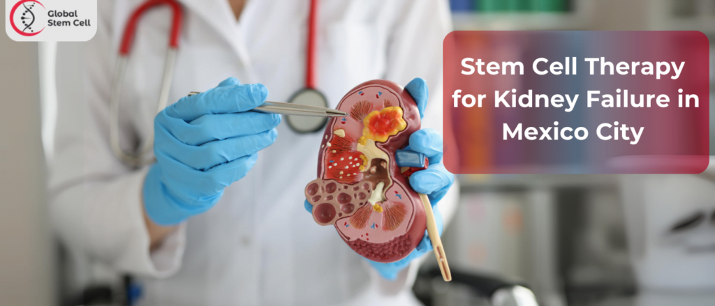 Stem Cell Therapy for Kidney Failure in Mexico City