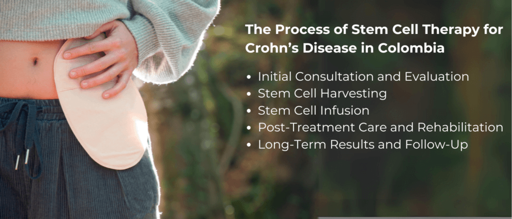 The Process of Stem Cell Therapy for Crohn’s Disease in Colombia 