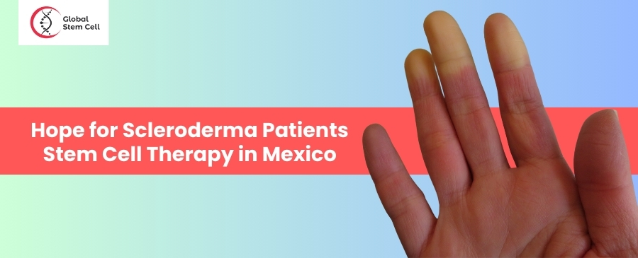 Terapia con células madre para pacientes con esclerodermia en México