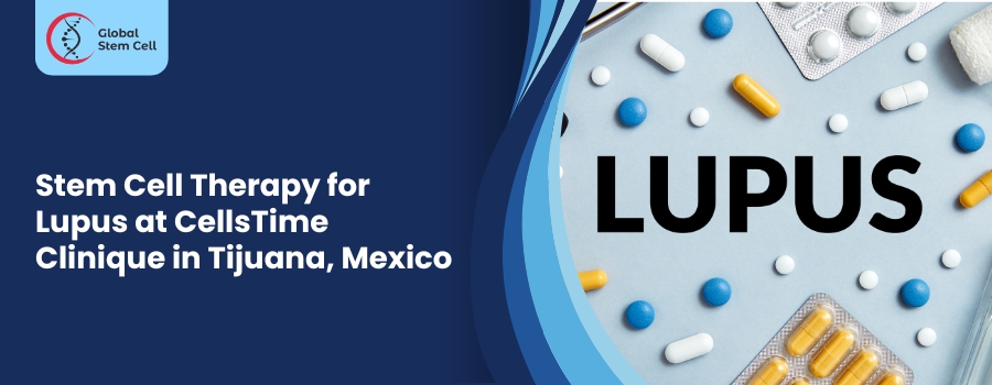 Stem Cell Therapy for Lupus at CellsTime Clinique in Tijuana, Mexico