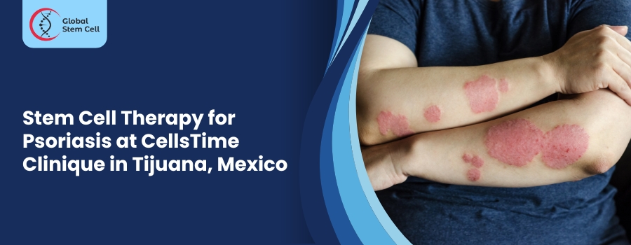 Stem Cell Therapy for Psoriasis at CellsTime Clinique in Tijuana, Mexico