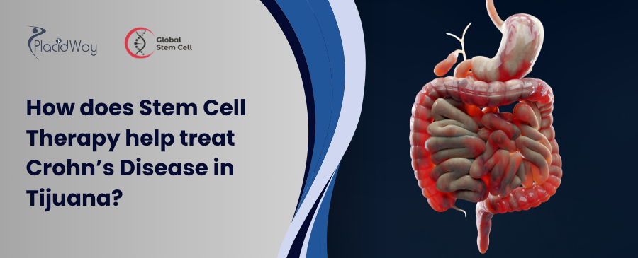 How does Stem Cell Therapy help stroke patients in Tijuana (2)