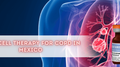 Stem Cell Treatment for COPD in Mexico