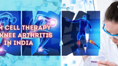 Stem Cell Therapy for Knee Arthritis in India