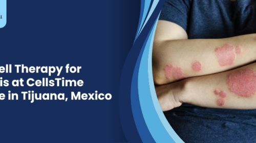 Stem Cell Therapy for Psoriasis at CellsTime Clinique in Tijuana, Mexico