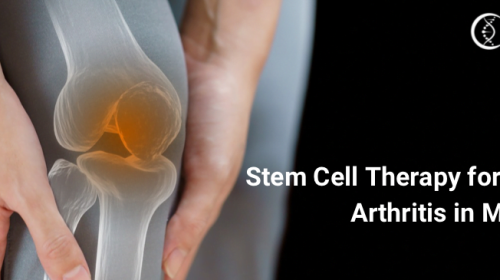 Stem cell therapy for knee arthritis in Mexico